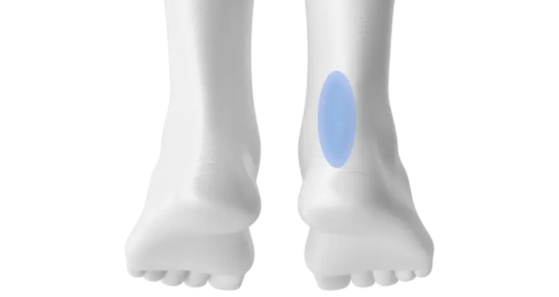 Achilles tendonitis