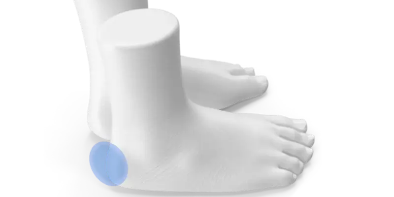 Heel bursitis