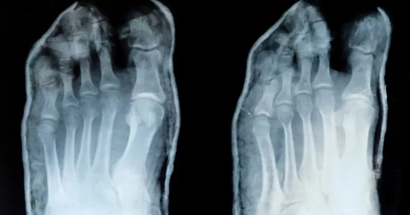 Osteoarthritis im Röntgenbild
